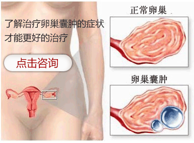 卵巢囊肿的危害有哪些?